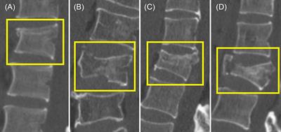 Automated detection and classification of acute vertebral body fractures using a convolutional neural network on computed tomography